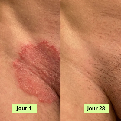 Solivya Savon Antifongique™